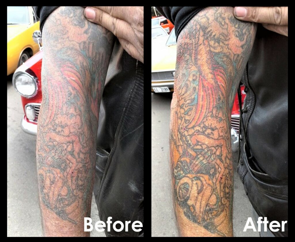 How to properly maintain a tattoo.

An example of a badly damaged boilermakers tattooed arm and the results of one light application of Tattman Enhancer Cream.
