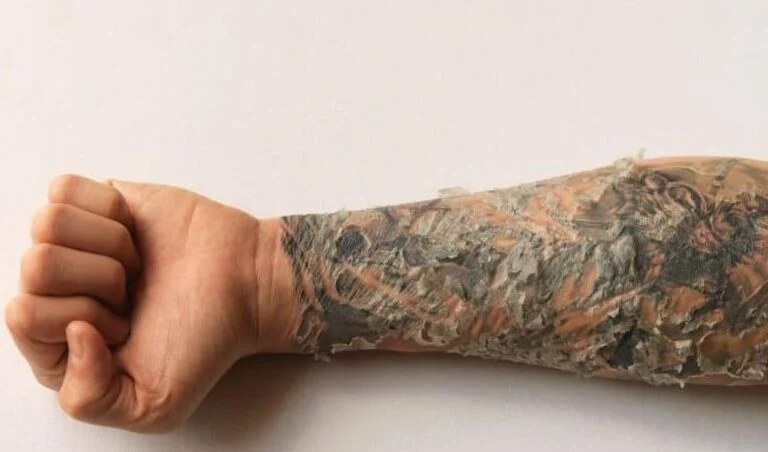 The Scabbing and Peeling Phase Requires Patience and Protection.